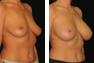 Breast Augmentation (Armpit Incision) Mentor Memory Gel Implants 375 cc