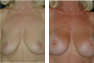 Breast Augmentation (Armpit Incision) Mentor Saline Implants 425cc