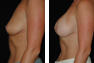Breast Augmentaiton (Nipple Incision) Mentor Saline Implants 325cc