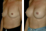 Breast Augmentation (Armpit Incision) Mentor Saline Implants 325cc