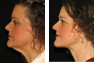 Necklift and Fat Grafting following Massive Weight Loss