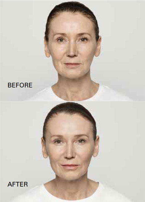 Dermal Fillers before and after photo