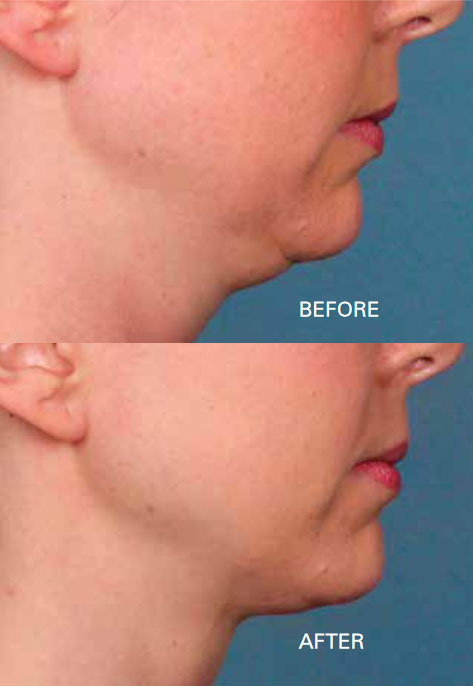 Kybella before and after photo