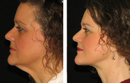 Neck lift before and after photo Neck lift before and after photo