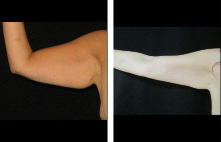 arm lift before and after photo arm lift before and after photo