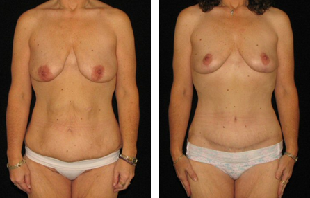 body contouring before and after photo body contouring before and after photo