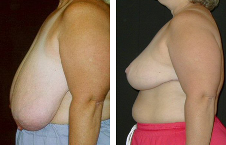 breast reduction before and after breast reduction before and after