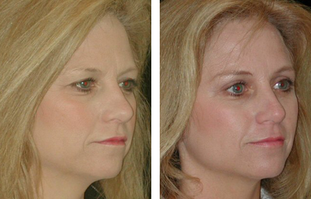 brow lift before and after photo brow lift before and after photo