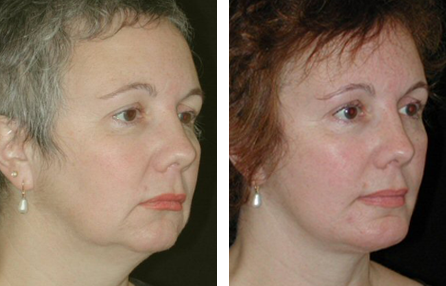 facial fat grafting before and after photo