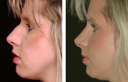 rhinoplasty before and after photo rhinoplasty before and after photo