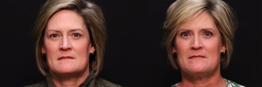 Upper Blepharoplasty before and after photo by Kirn Plastic Surgery and Skincare Center in Lexington, KY