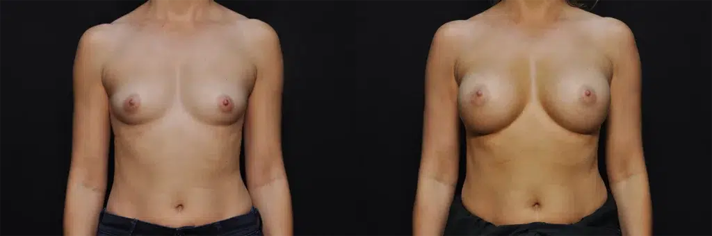 Breast Augmentation before and after photo by Kirn Plastic Surgery and Skincare Center in Lexington, KY