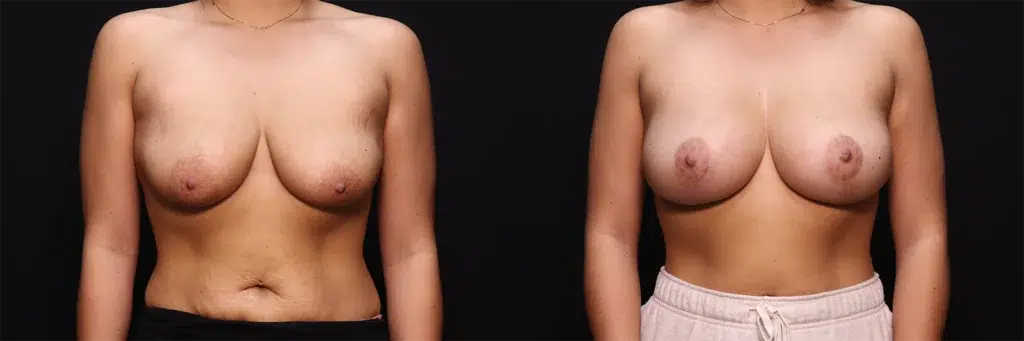 Breast Lift before and after photo by Kirn Plastic Surgery and Skincare Center in Lexington, KY