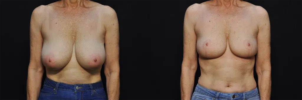 Breast Reduction before and after photo by Kirn Plastic Surgery and Skincare Center in Lexington, KY