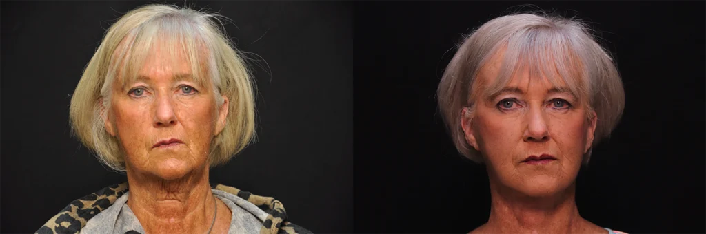 Facelift before and after photo by Kirn Plastic Surgery and Skincare Center in Lexington, KY