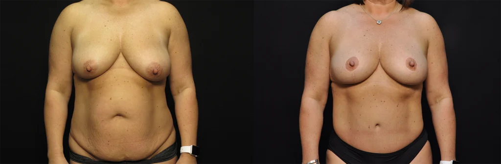 Mommy Makeover before and after photo by Kirn Plastic Surgery and Skincare Center in Lexington, KY