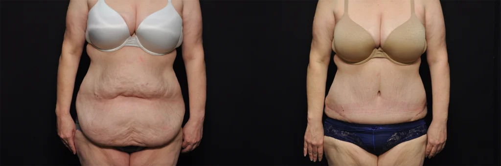 Tummy Tuck before and after photo by Kirn Plastic Surgery and Skincare Center in Lexington, KY