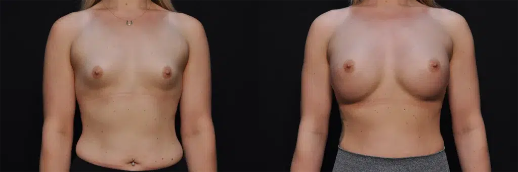 Breast Augmentation before and after photo by Kirn Plastic Surgery and Skincare Center in Lexington, KY
