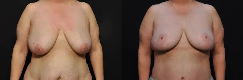 Breast Lift before and after photo by Kirn Plastic Surgery and Skincare Center in Lexington, KY