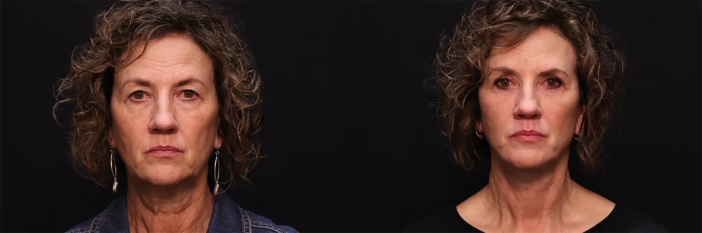 Eyes before and after photo by Kirn Plastic Surgery and Skincare Center in Lexington, KY