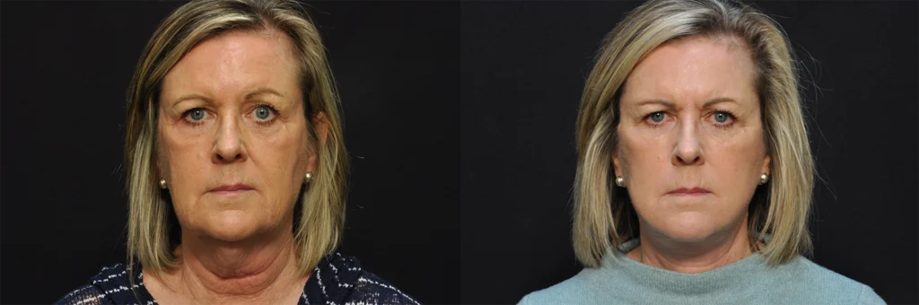 Fat Grafting before and after photo by Kirn Plastic Surgery and Skincare Center in Lexington, KY