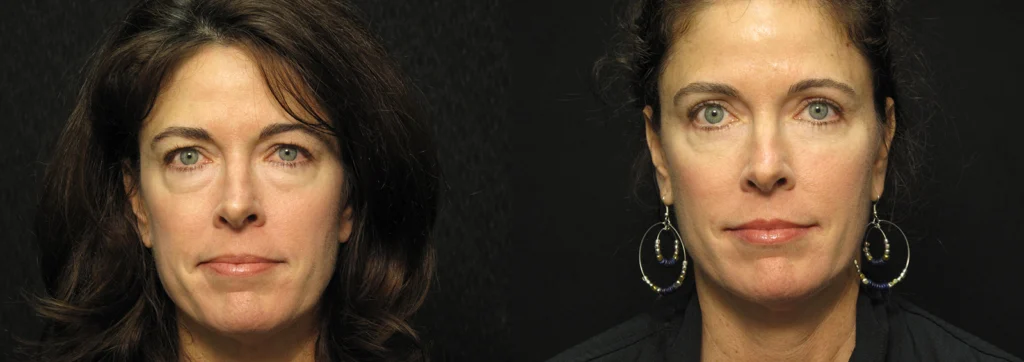 Eyes before and after photo by Kirn Plastic Surgery and Skincare Center in Lexington, KY