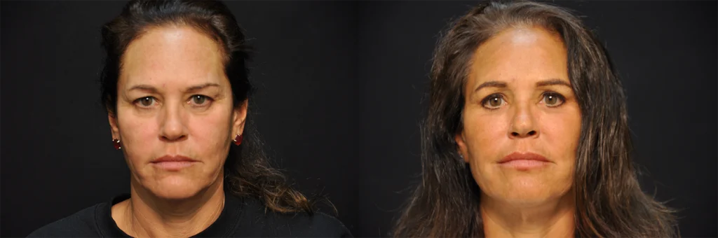 Eyes before and after photo by Kirn Plastic Surgery and Skincare Center in Lexington, KY