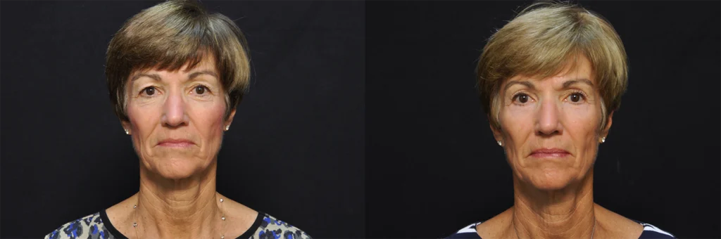 Eyes before and after photo by Kirn Plastic Surgery and Skincare Center in Lexington, KY