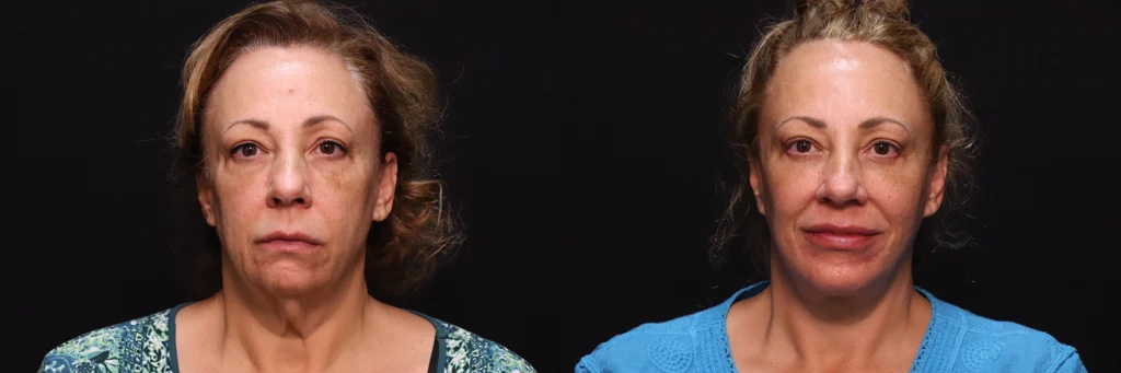 Eyes before and after photo by Kirn Plastic Surgery and Skincare Center in Lexington, KY