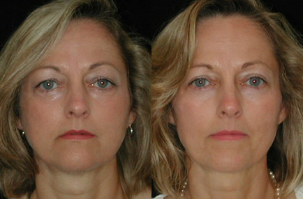 Blepharoplasty before and after photo by Kirn Plastic Surgery and Skincare Center in Lexington, KY