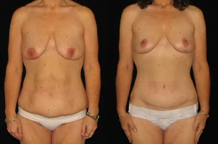 Body Contouring before and after photo by Kirn Plastic Surgery and Skincare Center in Lexington, KY
