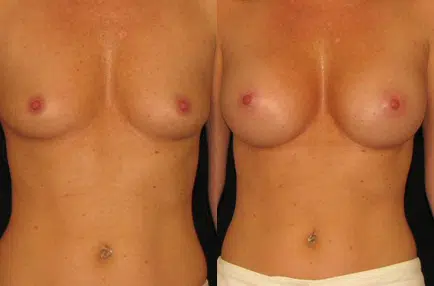 Breast Augmentation before and after photo by Kirn Plastic Surgery and Skincare Center in Lexington, KY