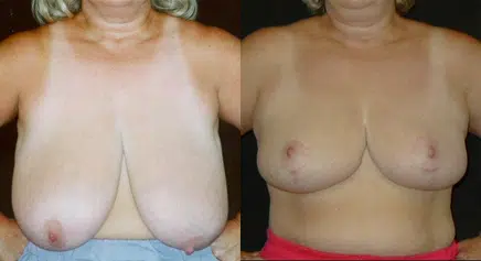 Breast Reduction before and after photo by Kirn Plastic Surgery and Skincare Center in Lexington, KY