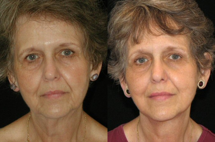 Facelift before and after photo by Kirn Plastic Surgery and Skincare Center in Lexington, KY