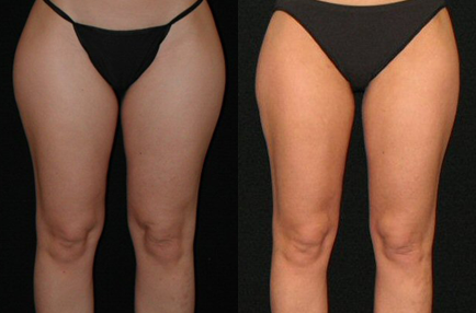 Liposuction before and after photo by Kirn Plastic Surgery and Skincare Center in Lexington, KY