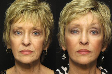 MACS Lift before and after photo by Kirn Plastic Surgery and Skincare Center in Lexington, KY