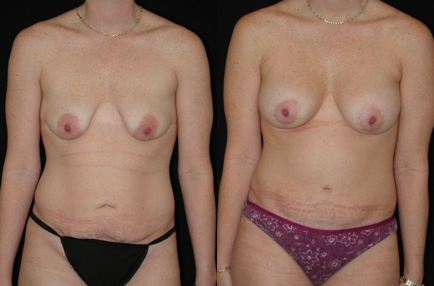 Mommy Makeover before and after photo by Kirn Plastic Surgery and Skincare Center in Lexington, KY