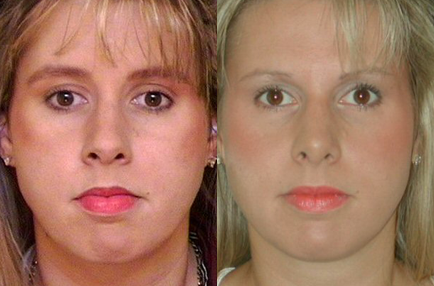 Rhinoplasty before and after photo by Kirn Plastic Surgery and Skincare Center in Lexington, KY
