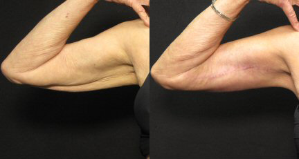 Arm Lift before and after photo by Kirn Plastic Surgery and Skincare Center in Lexington, KY