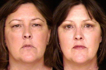 Blepharoplasty before and after photo by Kirn Plastic Surgery and Skincare Center in Lexington, KY