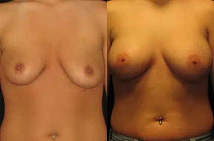Breast Augmentation before and after photo by Kirn Plastic Surgery and Skincare Center in Lexington, KY
