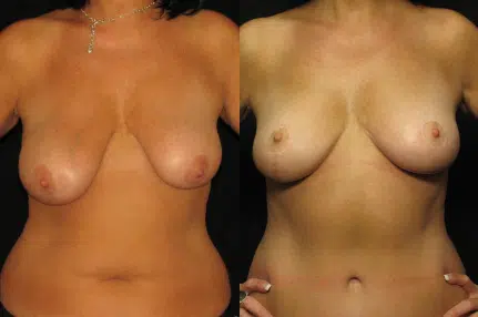 Breast Lift before and after photo by Kirn Plastic Surgery and Skincare Center in Lexington, KY