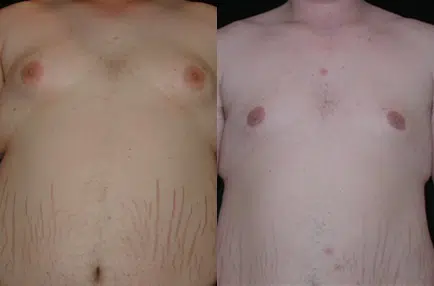 Breast Reduction before and after photo by Kirn Plastic Surgery and Skincare Center in Lexington, KY