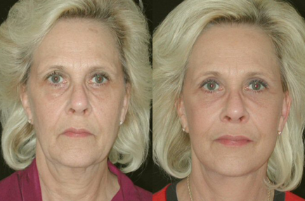 Facelift before and after photo by Kirn Plastic Surgery and Skincare Center in Lexington, KY