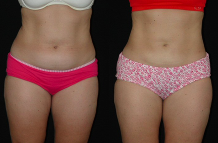 Liposuction before and after photo by Kirn Plastic Surgery and Skincare Center in Lexington, KY