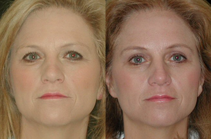 Blepharoplasty before and after photo by Kirn Plastic Surgery and Skincare Center in Lexington, KY