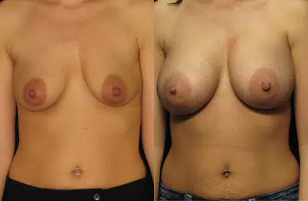 Breast Augmentation before and after photo by Kirn Plastic Surgery and Skincare Center in Lexington, KY