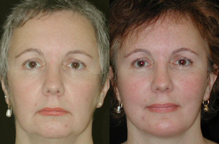 Facelift before and after photo by Kirn Plastic Surgery and Skincare Center in Lexington, KY