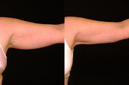Liposuction before and after photo by Kirn Plastic Surgery and Skincare Center in Lexington, KY