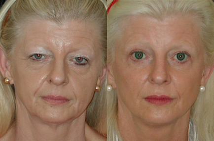 Blepharoplasty before and after photo by Kirn Plastic Surgery and Skincare Center in Lexington, KY